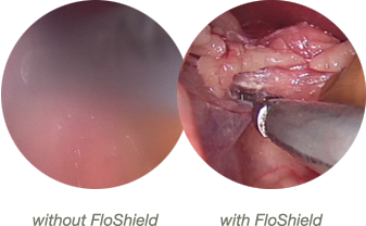 Laparoscope view with and without FloShield